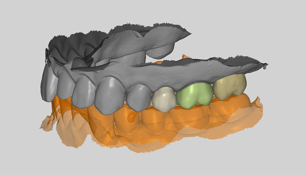 RAYDENT designerPatient-tailored tooth design with the aid of AI